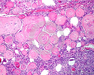 Meningioma. Psammoma bodies Stock Photo