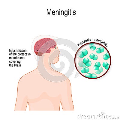 Meningitis and meningococcus bacterium that caused acute inflammation of the protective membranes covering the brain Vector Illustration