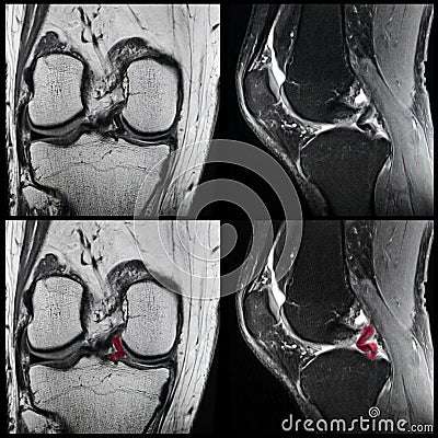 Knee ligament tear, MRI Stock Photo