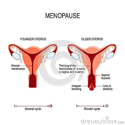 Menopause or climacteric. Younger and older women uterus Vector Illustration