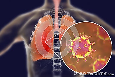 MERS virus, Meadle-East Respiratory Syndrome coronavirus Cartoon Illustration