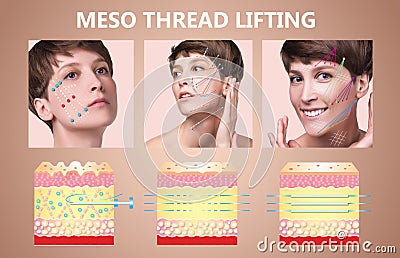 Meso thread Lift. Young female with clean fresh skin. Beautiful woman. face and neck. Stock Photo