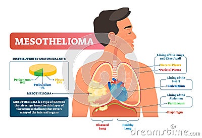 Mesothelioma vector illustration. Labeled lung cancer educational scheme. Vector Illustration