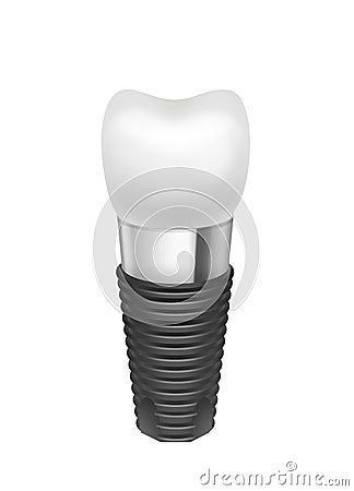 Metal assembled tooth implant Vector Illustration