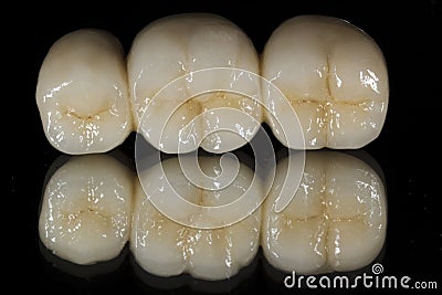 Metal ceramic bridge tooth unit Stock Photo