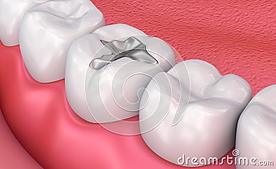 Metall dental fillings, Medically accurate illustration Cartoon Illustration