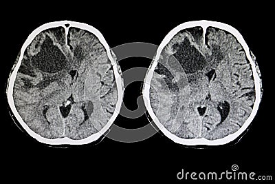 metastatic brain tumor Stock Photo