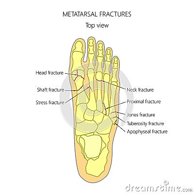 Metatarsal fractures Vector Illustration
