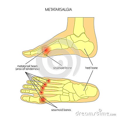 Metatarsalgia Vector Illustration