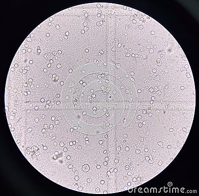 Microorganism and white blood cell in urine Stock Photo