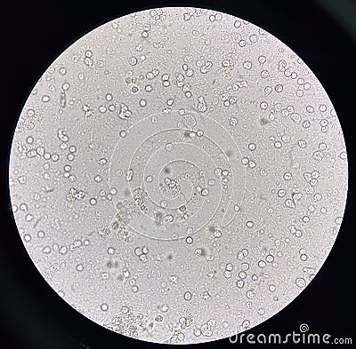 Microorganism and white blood cell in urine Stock Photo