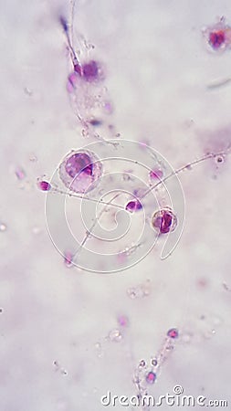 Microphotography show Spermatic inmature cell and white blood cell Stock Photo
