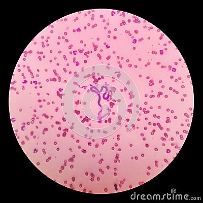 Microscopic examination of stained blood films used to differentiate microfilariae. Stock Photo