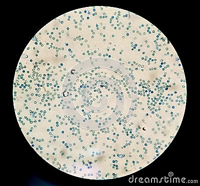 Microscopic image of abnormal high reticulocytes count . Nucleated RBC or nRBC test at medical laboratory. Stock Photo