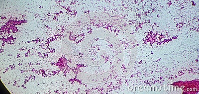 Microscopic image of a cytology of a non-small cell lung tumor. Medical themes Stock Photo