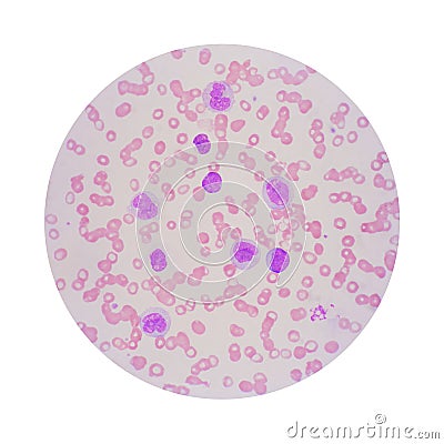 Microscopic view of a blood smear from leukemia patient showing Stock Photo