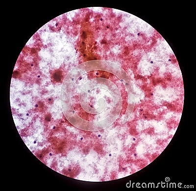 Microscopic view of CT guided fine needle aspiration cytology (FNAC) of a patient. Carcinoma, malignancy. Stock Photo