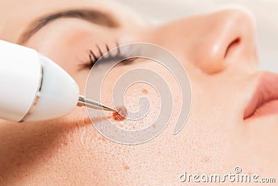 Microsurgery. Removal of birthmark from client`s cheek with laser device. Close up. Concept of laser cosmelotogy and Stock Photo