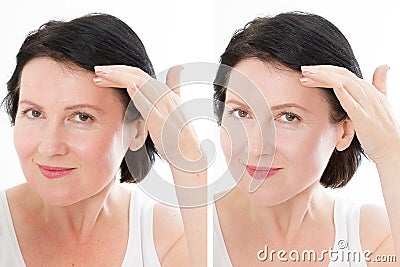 Middle age close up forehead woman happy face before after cosmetic procedures. Skin care for wrinkled face. Before-after anti- Stock Photo