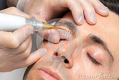 Middle aged man having laser plasma pen therapy on eyelids Stock Photo