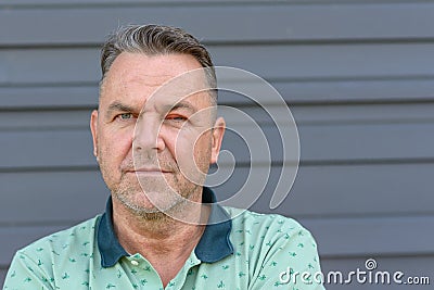 Middle-aged man with swollen inflamed eye Stock Photo