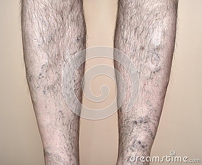 Legs of a man with varicose veins and capillaries Stock Photo