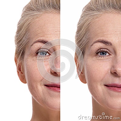 Middle aged oman face before and after cosmetic procedure. Plastic surgery concept. Stock Photo