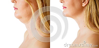 Woman before and after chin fat correction procedure Stock Photo