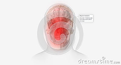 Migraine headaches are characterized by recurrent, throbbing pain affecting one side of the head Stock Photo