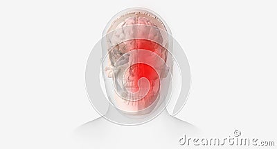 Migraine headaches are characterized by recurrent, throbbing pain affecting one side of the head Stock Photo