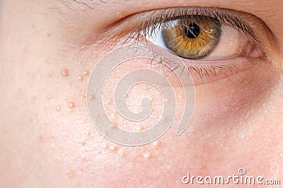 Milia (Milium) - pimples around eye on skin Stock Photo