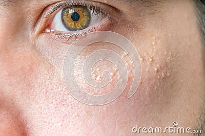 Milia (Milium) - pimples around eye on skin Stock Photo