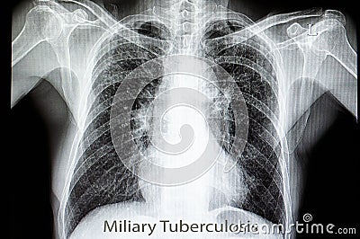 miliary pulmonary tuberculosis Stock Photo