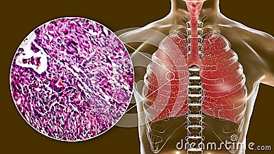 Miliary tuberculosis, illustration and light micrograph Cartoon Illustration