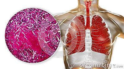 Miliary tuberculosis, illustration and light micrograph Cartoon Illustration