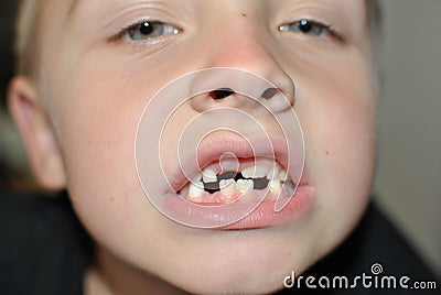 Milk teeth Stock Photo
