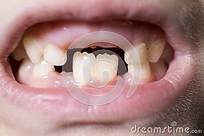 Milk tooth children mouth Stock Photo