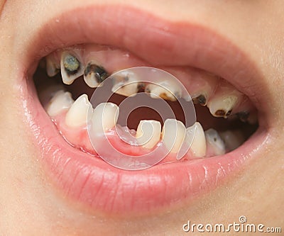 milk tooth Stock Photo