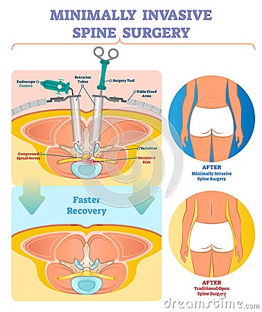 Minimally invasive spine surgery vector illustration. Labeled diagram. Vector Illustration
