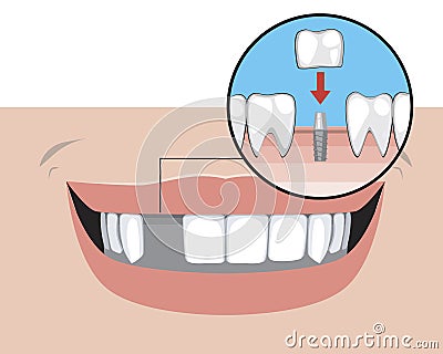 Missing tooth and implant on a pin with a smile as a treatment concept in a dental or orthodontic clinic, a stock Vector Illustration