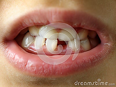 Missing tooth smile kid or children mouth closeup or macro Stock Photo