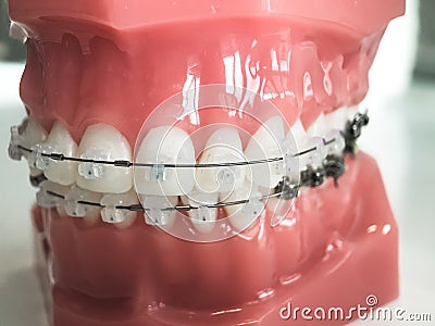 Model of human jaw with wire braces attached. Dental and orthodontic office and lab presentation tool, dental care and Stock Photo