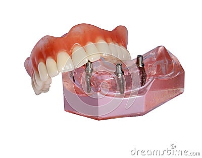 Model of a jaw and denture 2 Stock Photo