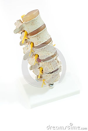 Model of spinal disc herniation Stock Photo