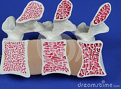 Model of spine showing porous bone marrow in case of osteoporosis Stock Photo