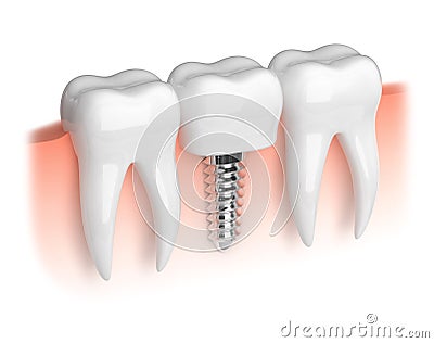 Model of teeth and dental implant Stock Photo