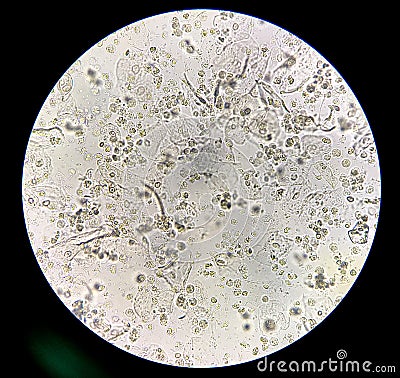 Moderate bacteria and white blood cells in patien bacteria urinary tract infection Stock Photo