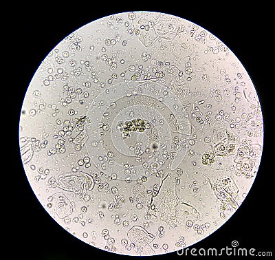 Moderate bacteria and white blood cells in patien bacteria urinary tract infection Stock Photo