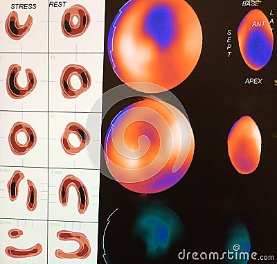 Scintigraphy imaging of a heart Stock Photo