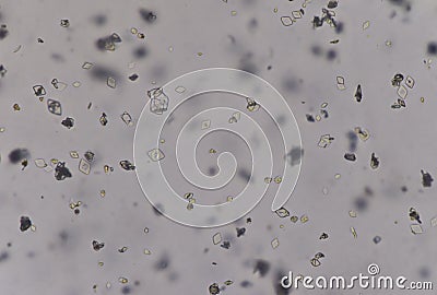 Moderate uric acid crystals in urine Stock Photo